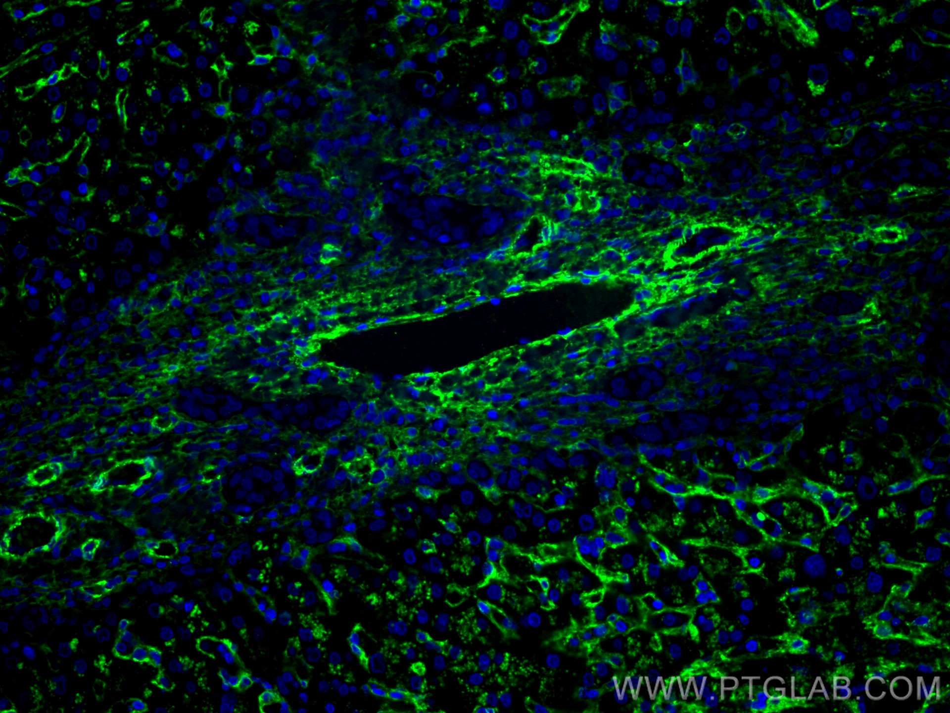 Immunofluorescence (IF) / fluorescent staining of human liver cancer tissue using CoraLite® Plus 488-conjugated AOC3 Monoclonal anti (CL488-66834)