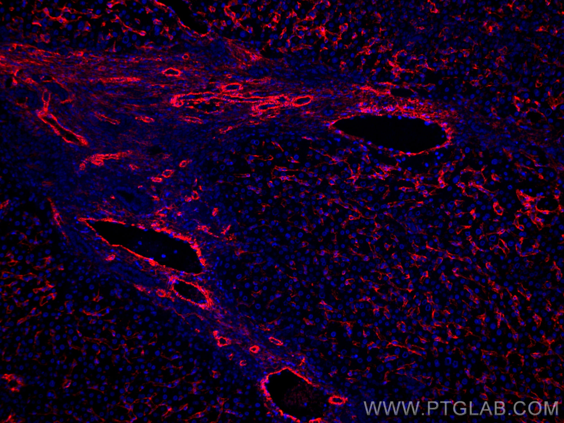 Immunofluorescence (IF) / fluorescent staining of human liver cancer tissue using CoraLite®594-conjugated AOC3 Monoclonal antibody (CL594-66834)