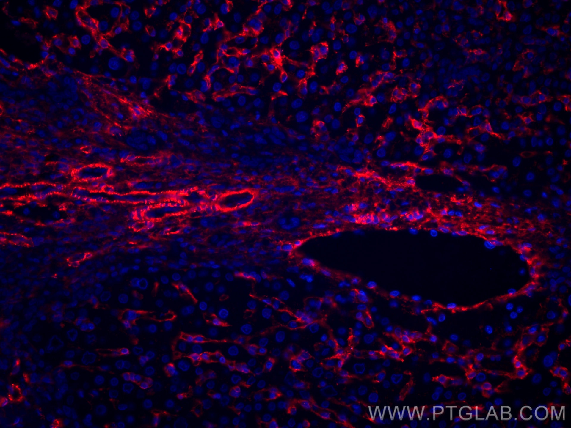 Immunofluorescence (IF) / fluorescent staining of human liver cancer tissue using CoraLite®594-conjugated AOC3 Monoclonal antibody (CL594-66834)