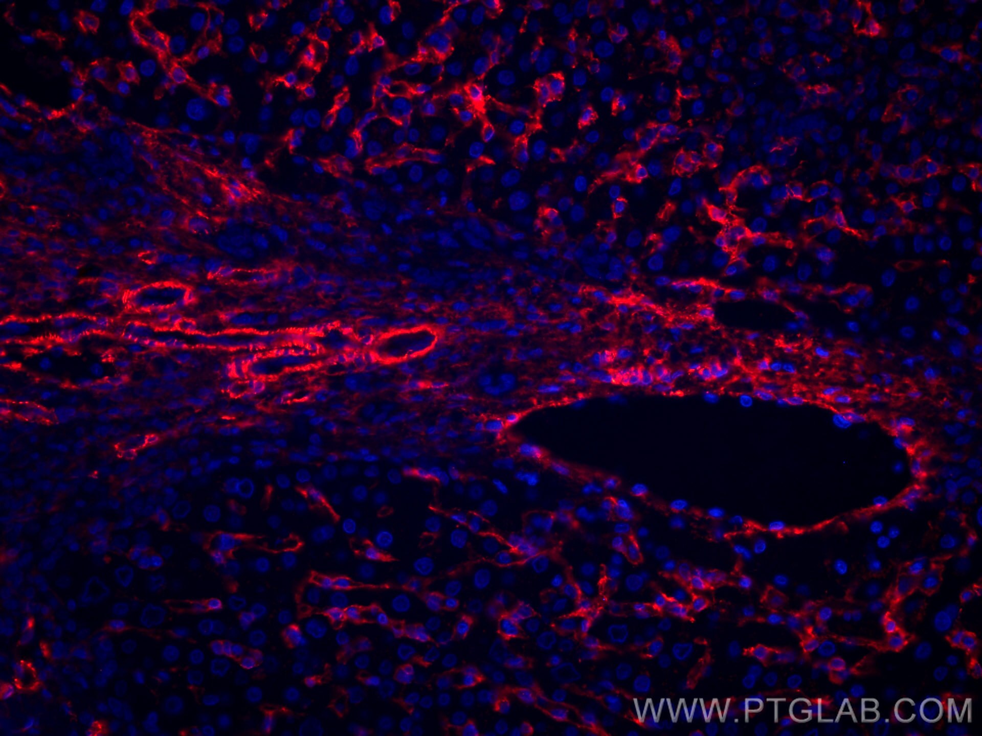 Immunofluorescence (IF) / fluorescent staining of human liver cancer tissue using CoraLite®594-conjugated AOC3 Monoclonal antibody (CL594-66834)