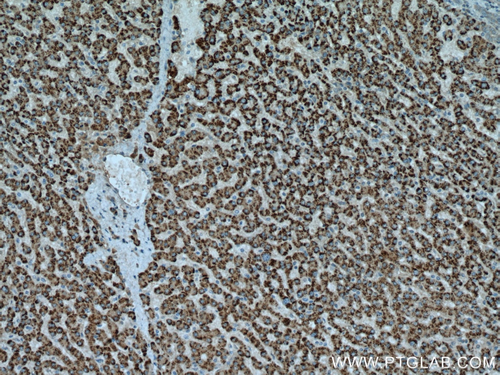 Immunohistochemistry (IHC) staining of human liver cancer tissue using ACOX1 Polyclonal antibody (10957-1-AP)