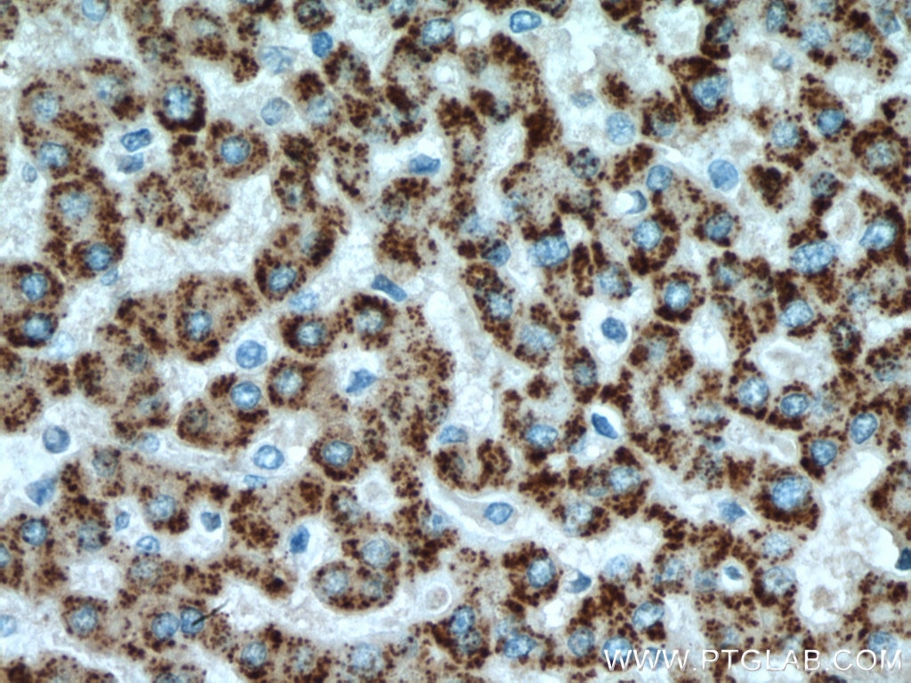 Immunohistochemistry (IHC) staining of human liver cancer tissue using ACOX1 Polyclonal antibody (10957-1-AP)