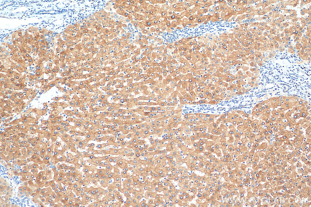 Immunohistochemistry (IHC) staining of human hepatocirrhosis tissue using Aldehyde oxidase Polyclonal antibody (19495-1-AP)