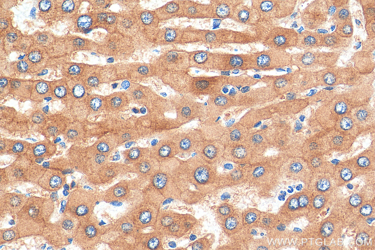 Immunohistochemistry (IHC) staining of human hepatocirrhosis tissue using Aldehyde oxidase Polyclonal antibody (19495-1-AP)