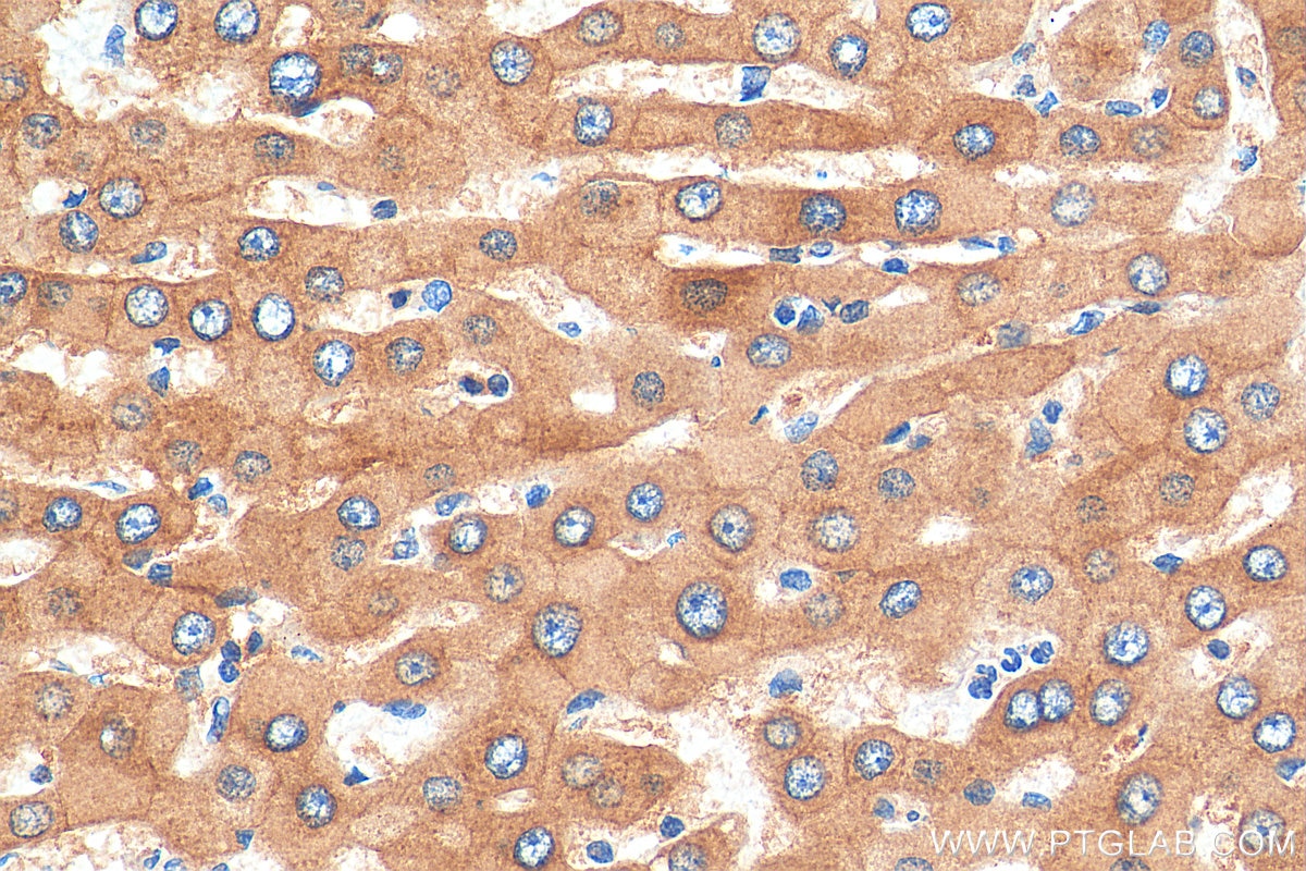 IHC staining of human hepatocirrhosis using 19495-1-AP