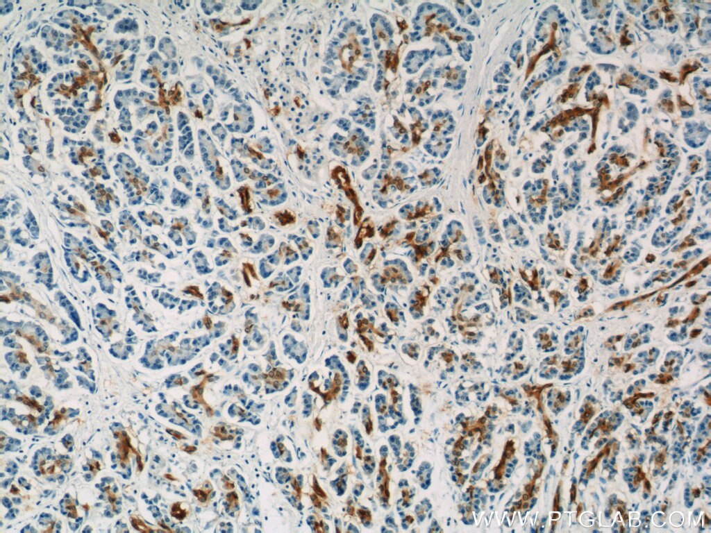 Immunohistochemistry (IHC) staining of human pancreas cancer tissue using Gamma Adaptin Polyclonal antibody (13258-1-AP)