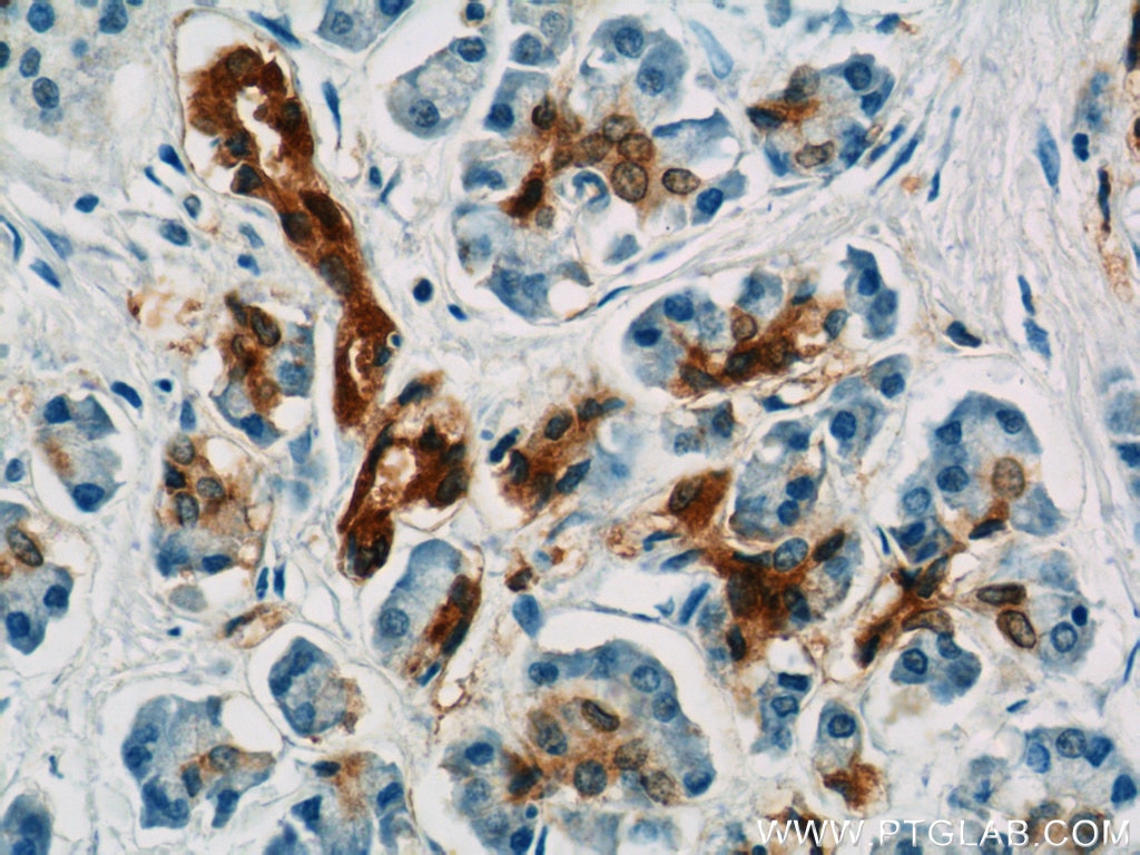 Immunohistochemistry (IHC) staining of human pancreas cancer tissue using Gamma Adaptin Polyclonal antibody (13258-1-AP)