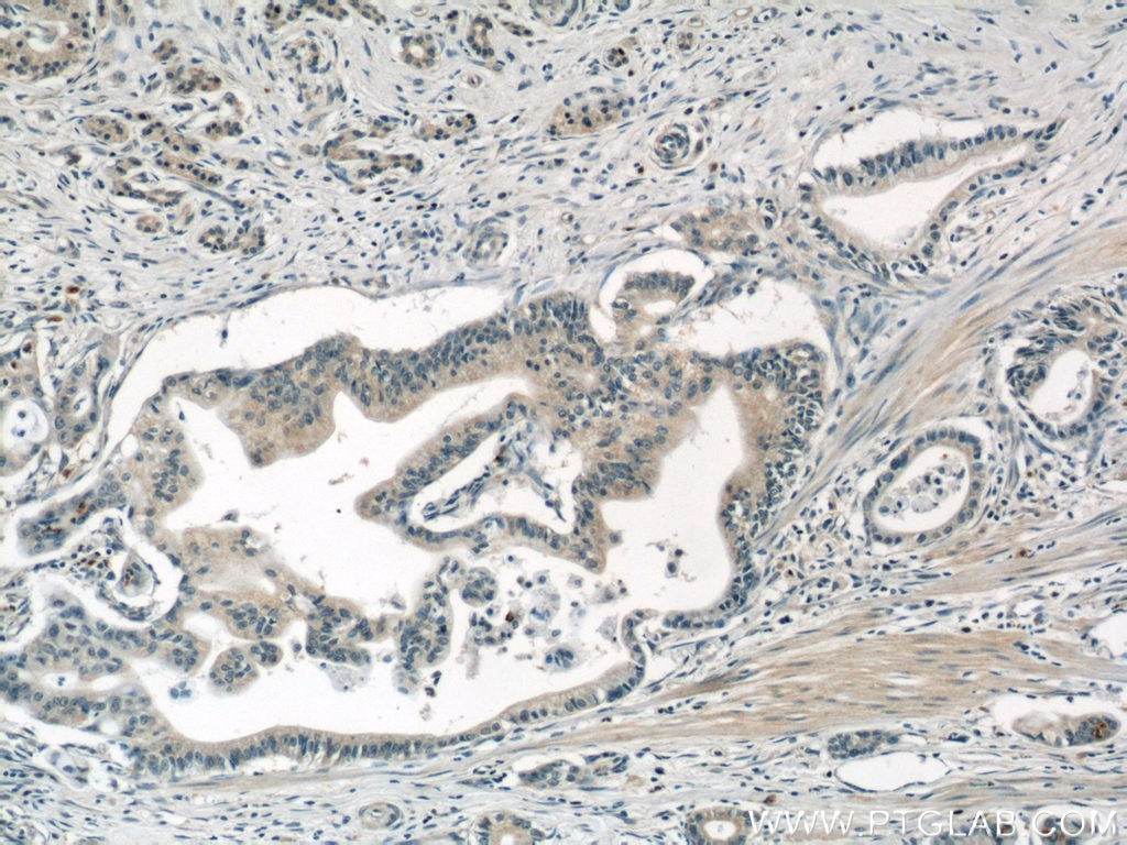 Immunohistochemistry (IHC) staining of human pancreas cancer tissue using AP1M2 Polyclonal antibody (10618-1-AP)