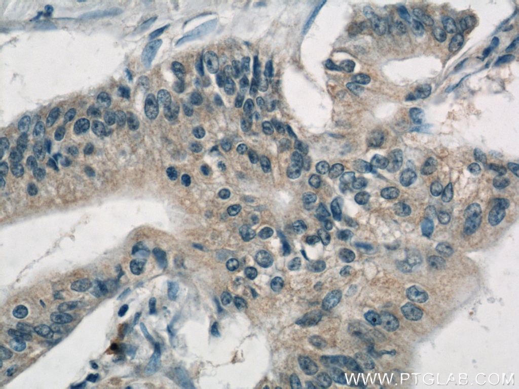 Immunohistochemistry (IHC) staining of human pancreas cancer tissue using AP1M2 Polyclonal antibody (10618-1-AP)