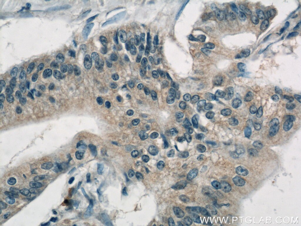 IHC staining of human pancreas cancer using 10618-1-AP