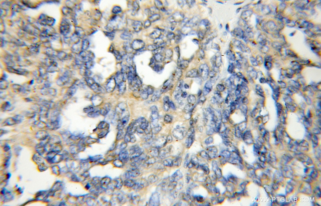 Immunohistochemistry (IHC) staining of human ovary tumor tissue using Alpha Adaptin Polyclonal antibody (11401-1-AP)