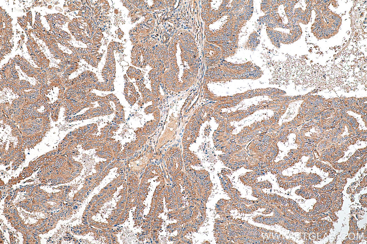IHC staining of human ovary tumor using 29887-1-AP