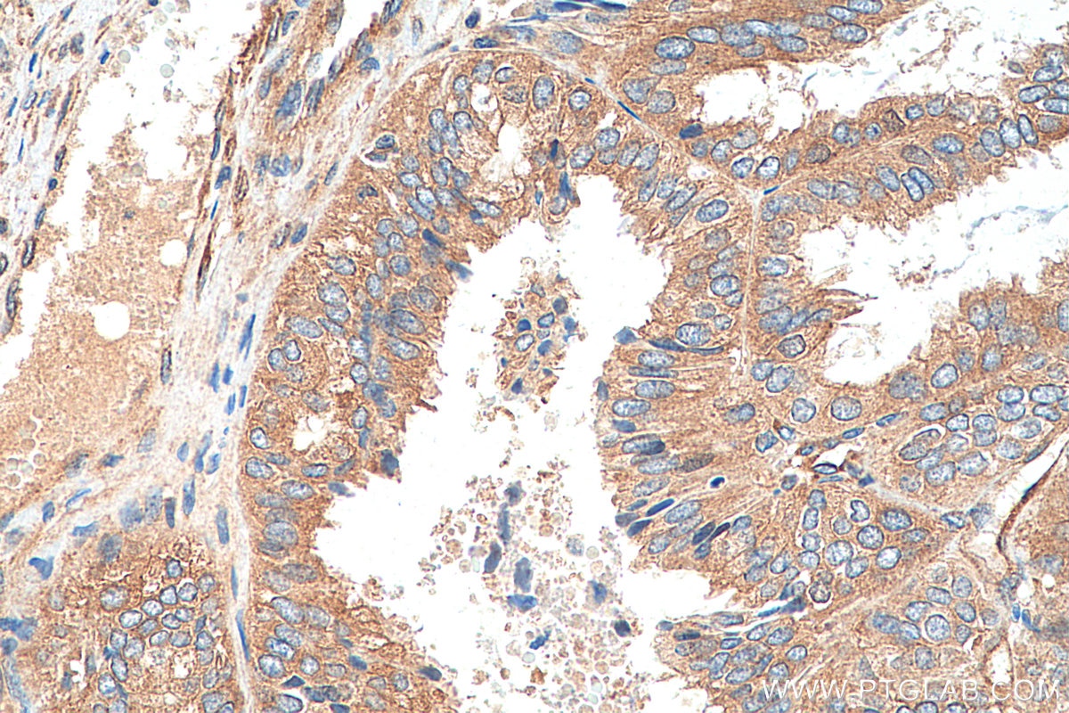Immunohistochemistry (IHC) staining of human ovary tumor tissue using AP2A1 Polyclonal antibody (29887-1-AP)
