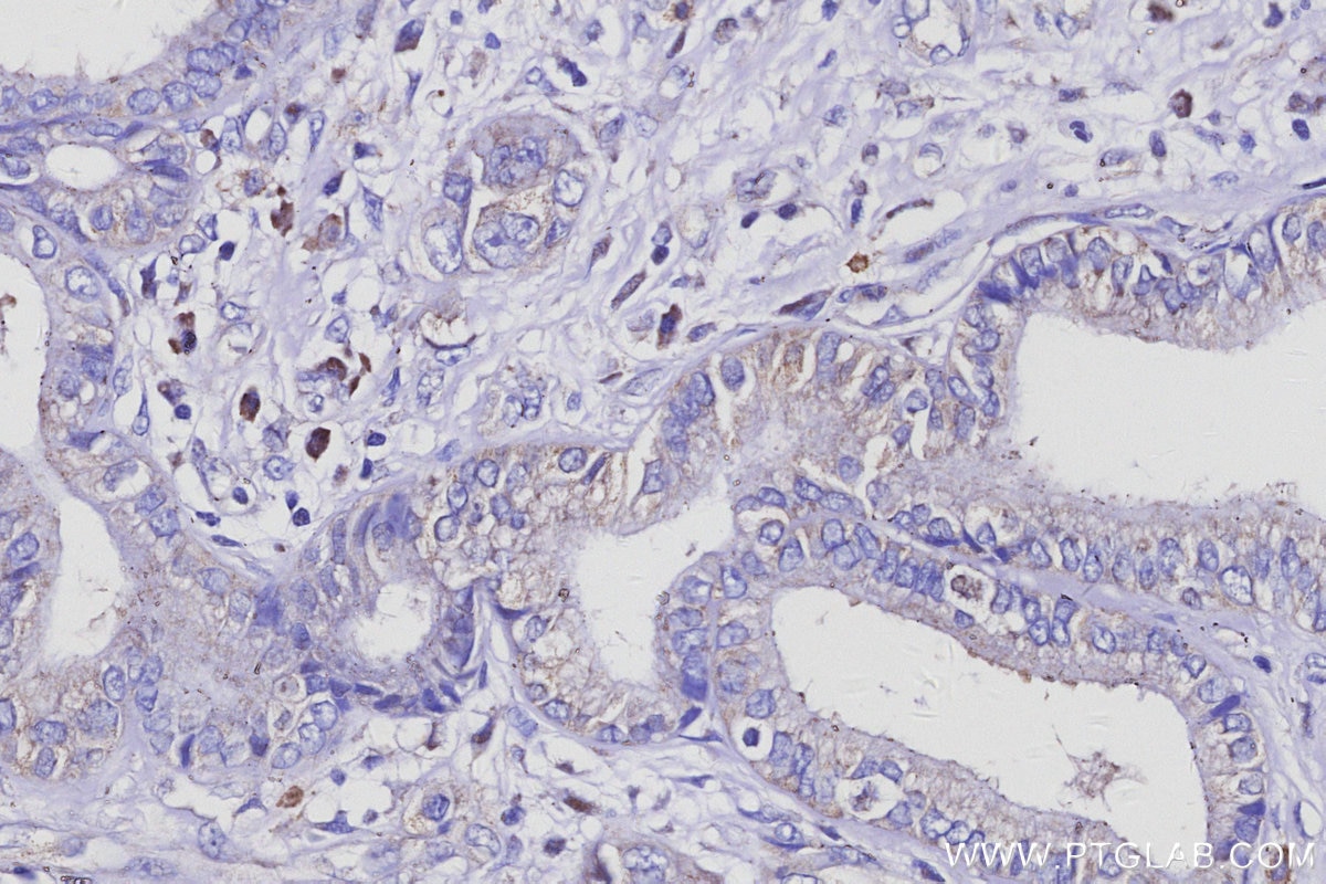 Immunohistochemistry (IHC) staining of human pancreas cancer tissue using AP3B1 Polyclonal antibody (13384-1-AP)