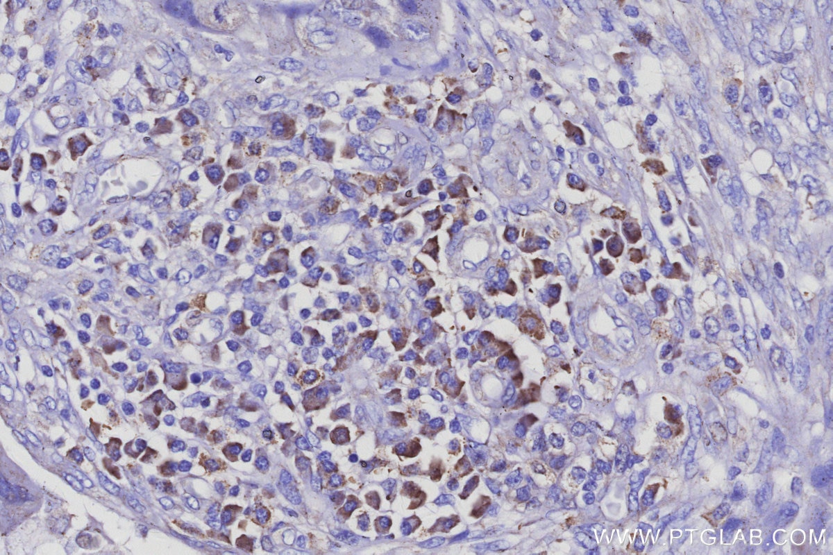 Immunohistochemistry (IHC) staining of human pancreas cancer tissue using AP3B1 Polyclonal antibody (13384-1-AP)