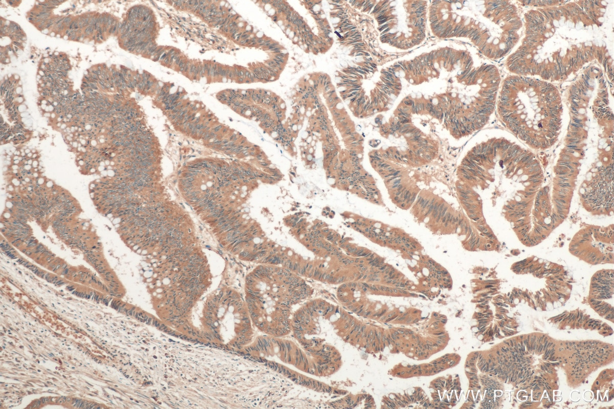 Immunohistochemistry (IHC) staining of human colon cancer tissue using AP3S2 Polyclonal antibody (15319-1-AP)
