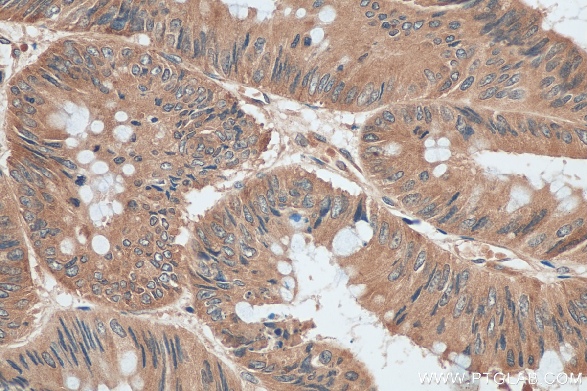 Immunohistochemistry (IHC) staining of human colon cancer tissue using AP3S2 Polyclonal antibody (15319-1-AP)