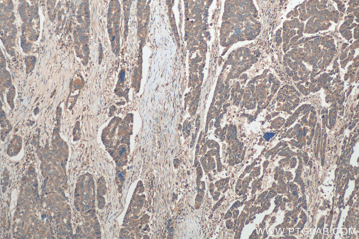 Immunohistochemistry (IHC) staining of human ovary tumor tissue using AP3S2 Polyclonal antibody (15319-1-AP)