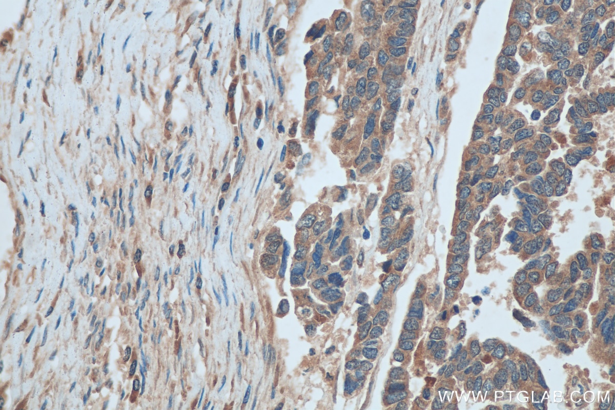 Immunohistochemistry (IHC) staining of human ovary tumor tissue using AP3S2 Polyclonal antibody (15319-1-AP)
