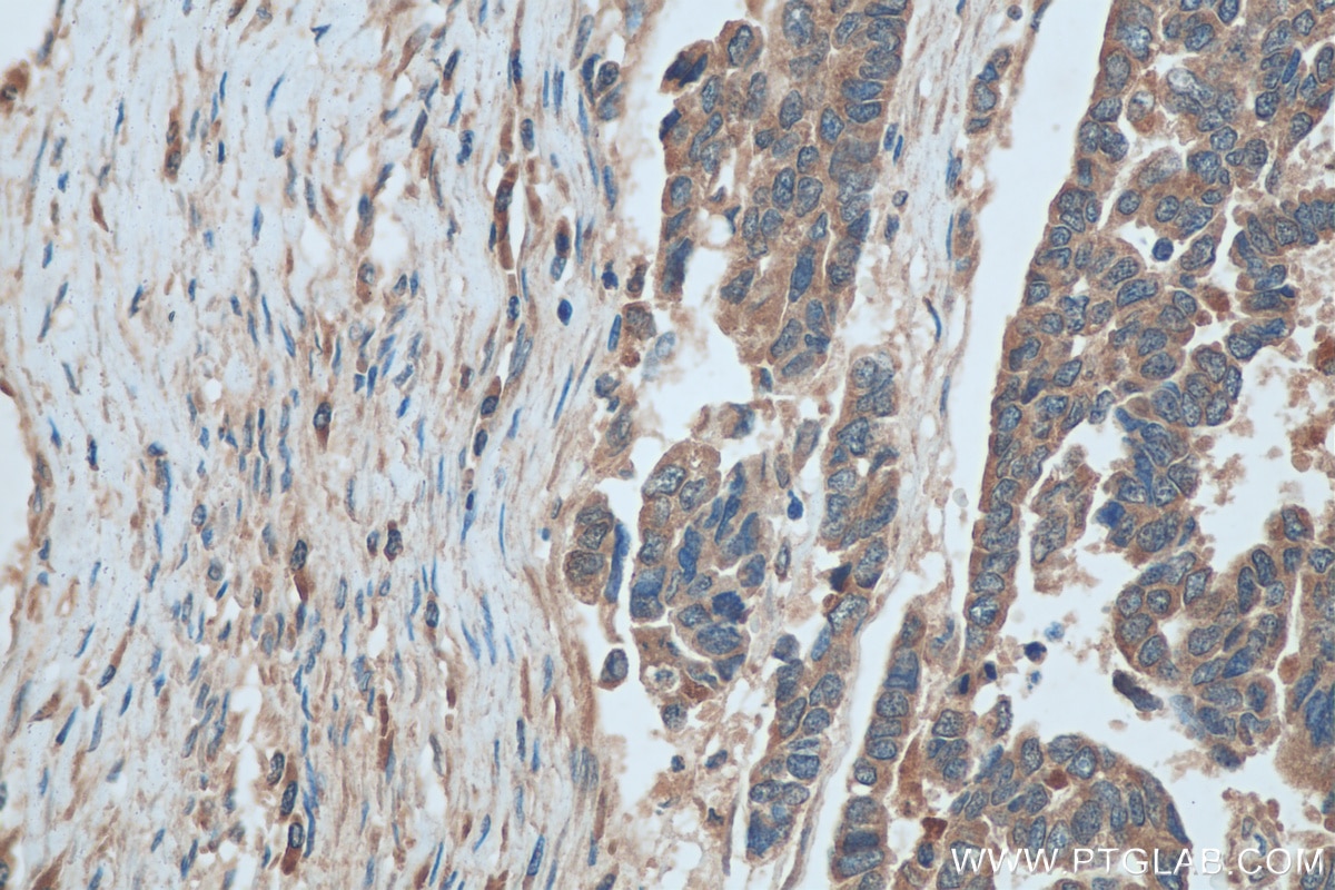 IHC staining of human ovary tumor using 15319-1-AP