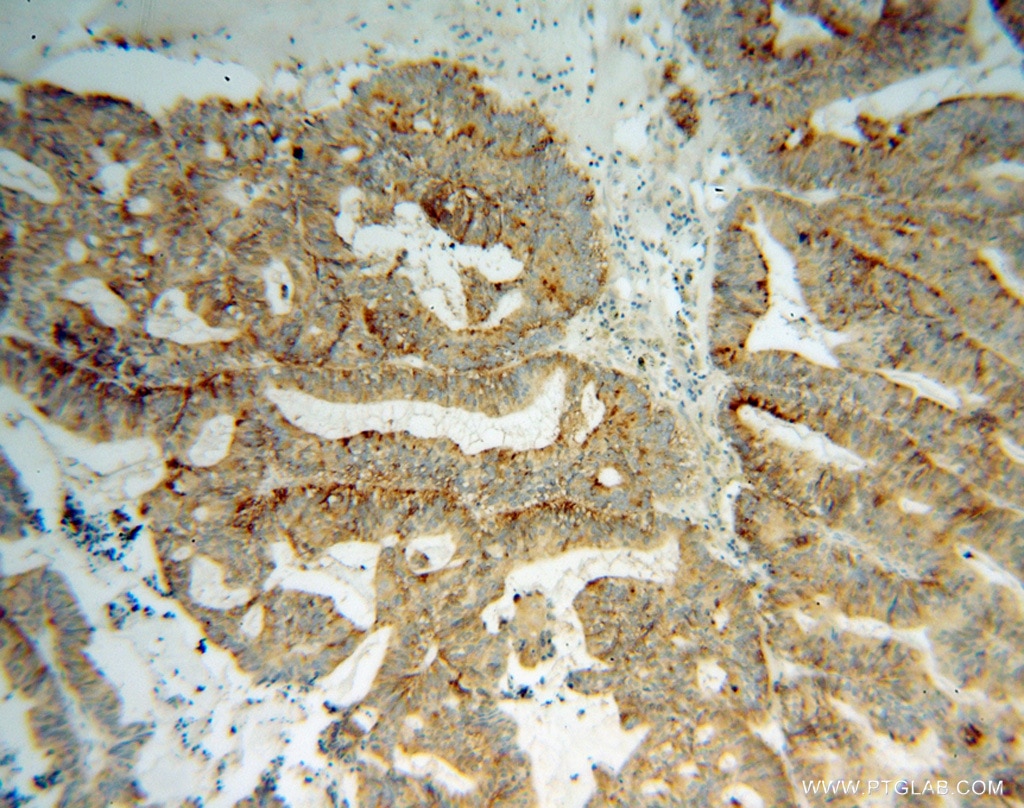 Immunohistochemistry (IHC) staining of human ovary tumor tissue using AP3S2 Polyclonal antibody (15319-1-AP)