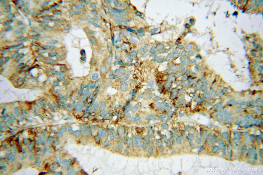 Immunohistochemistry (IHC) staining of human ovary tumor tissue using AP3S2 Polyclonal antibody (15319-1-AP)