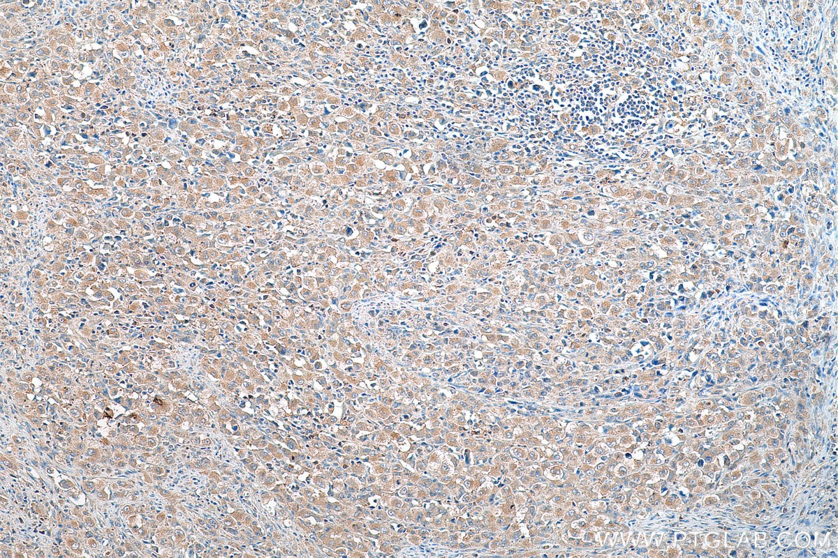 Immunohistochemistry (IHC) staining of human lymphoma tissue using AP4M1 Polyclonal antibody (11653-1-AP)