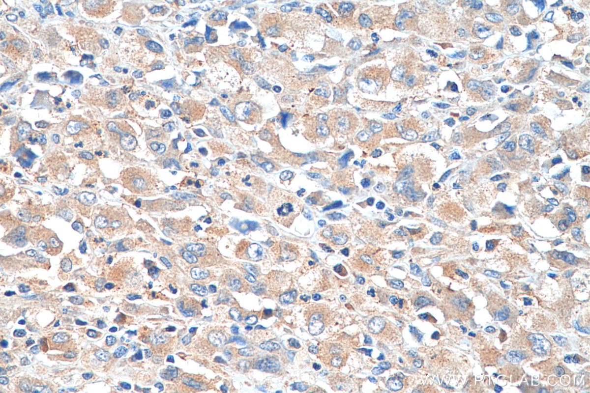 IHC staining of human lymphoma using 11653-1-AP