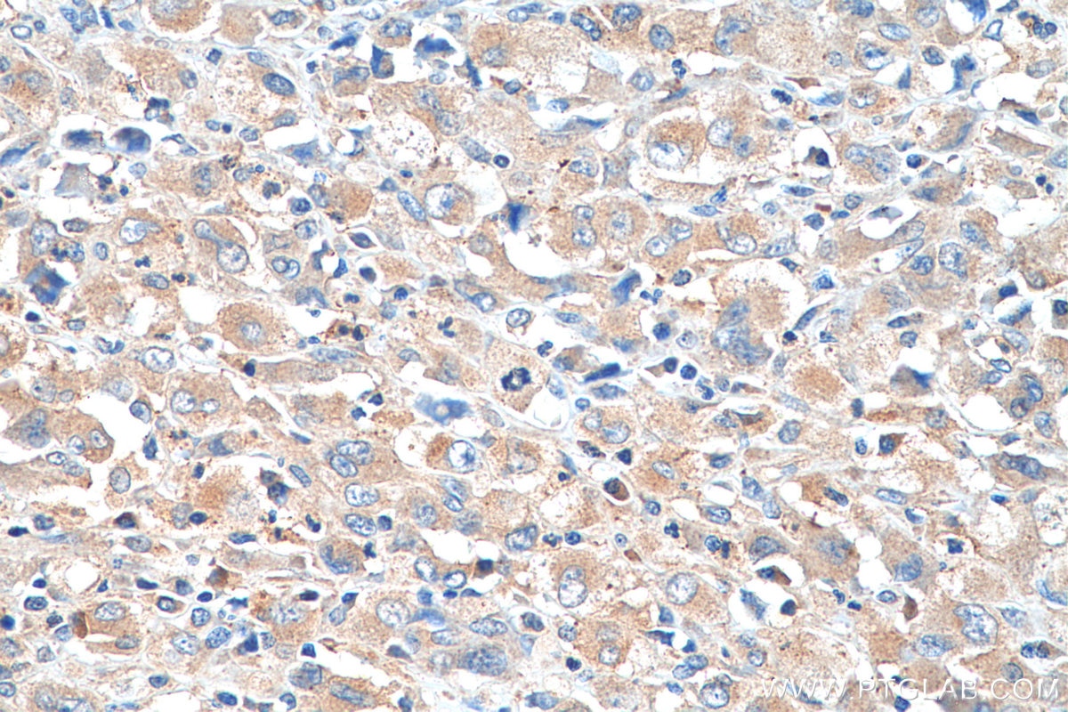 Immunohistochemistry (IHC) staining of human lymphoma tissue using AP4M1 Polyclonal antibody (11653-1-AP)