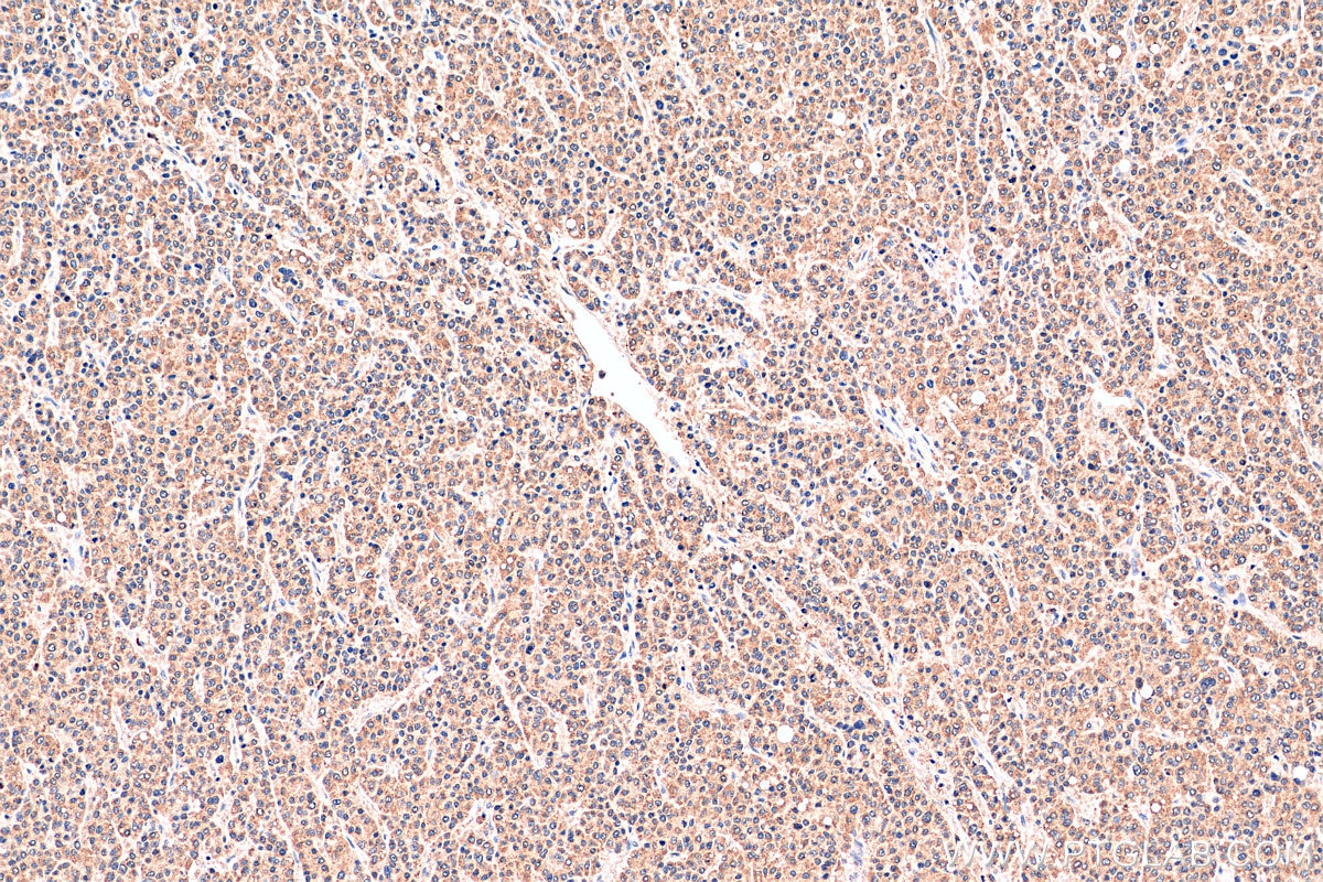 Immunohistochemistry (IHC) staining of human liver cancer tissue using AP5Z1/SPG48 Monoclonal antibody (66533-1-Ig)