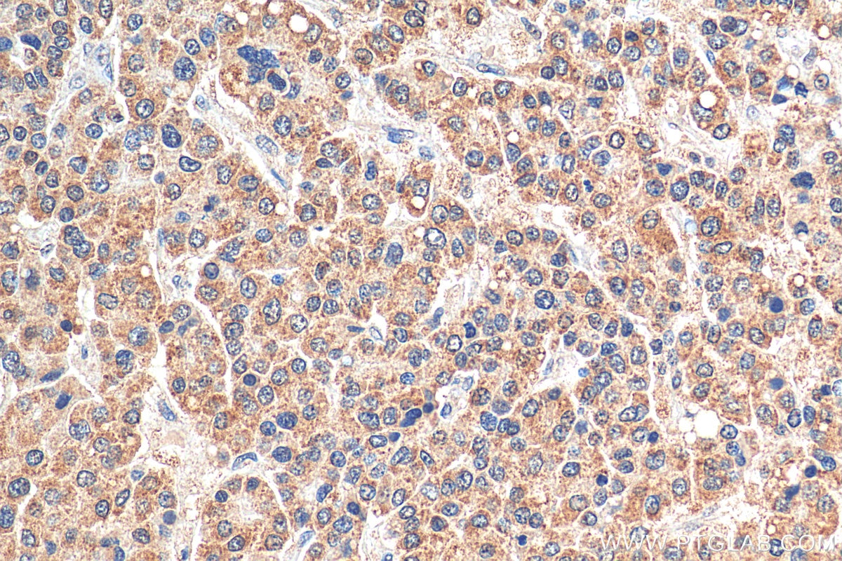 Immunohistochemistry (IHC) staining of human liver cancer tissue using AP5Z1/SPG48 Monoclonal antibody (66533-1-Ig)