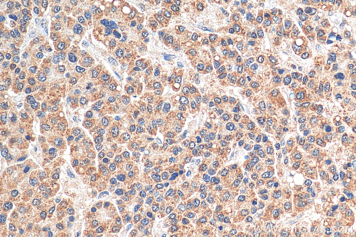 IHC staining of human liver cancer using 66533-1-Ig