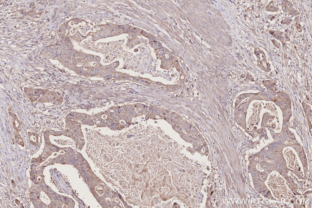 Immunohistochemistry (IHC) staining of human stomach cancer tissue using APBB2 Polyclonal antibody (13177-1-AP)
