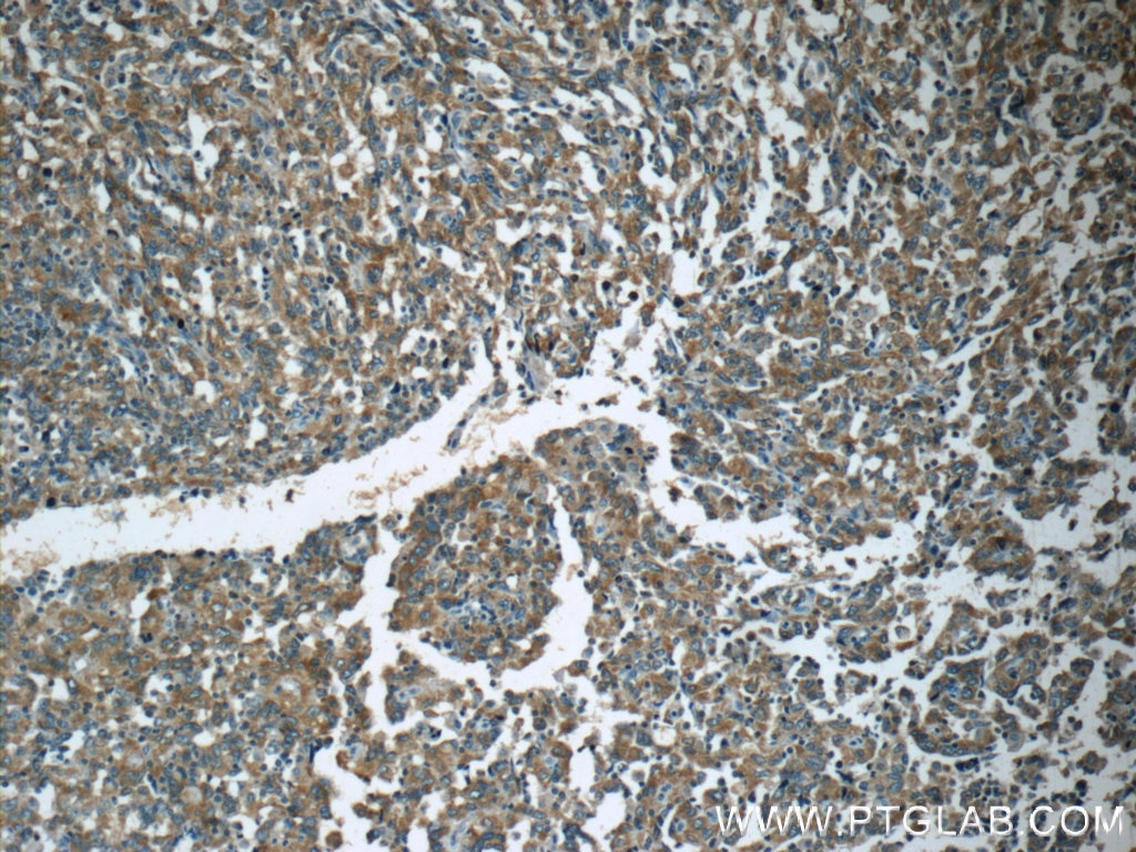 IHC staining of human endometrial cancer using 19782-1-AP
