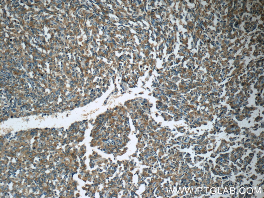 Immunohistochemistry (IHC) staining of human endometrial cancer tissue using APC Polyclonal antibody (19782-1-AP)