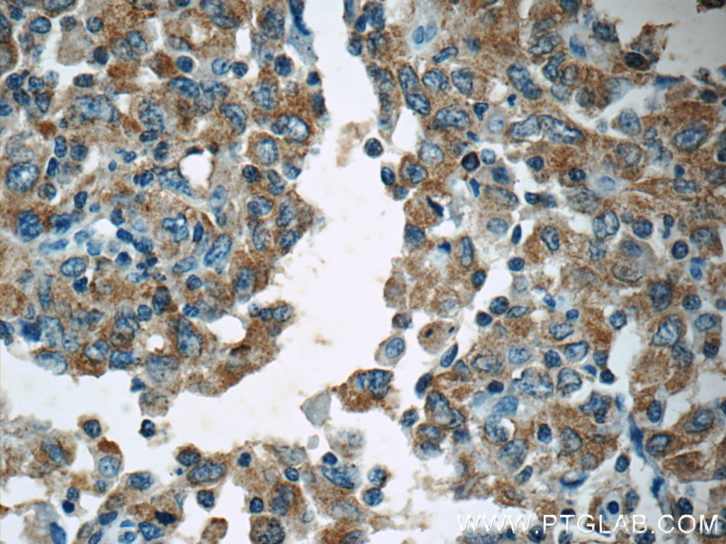 Immunohistochemistry (IHC) staining of human endometrial cancer tissue using APC Polyclonal antibody (19782-1-AP)