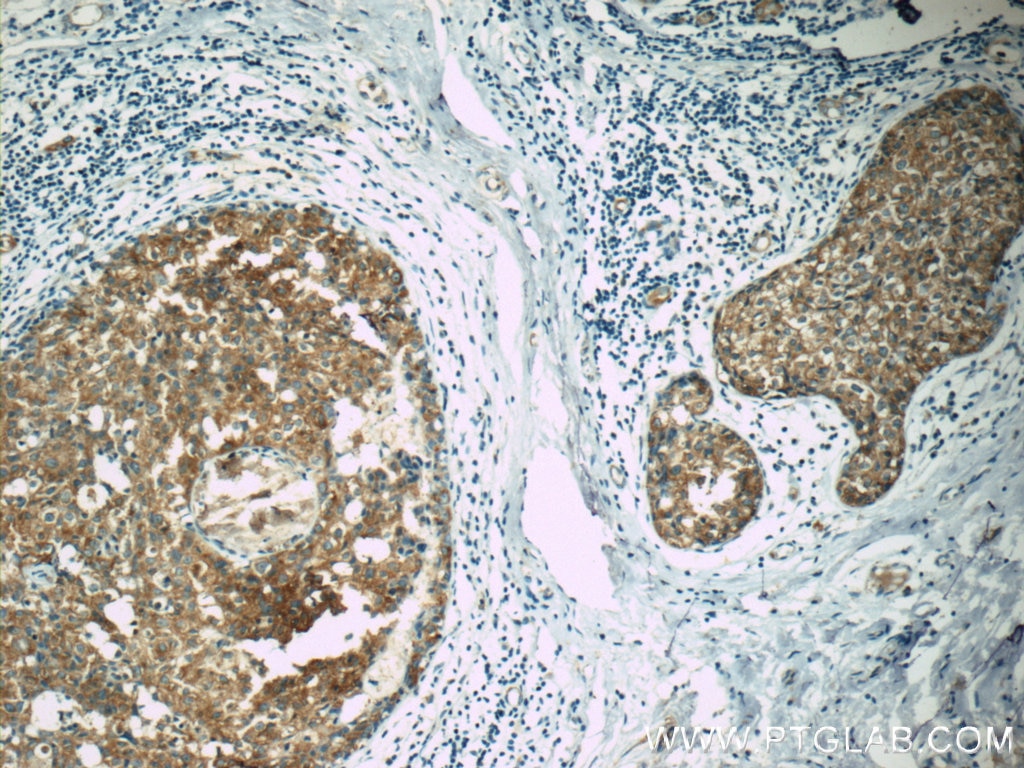 Immunohistochemistry (IHC) staining of human breast cancer tissue using APC Polyclonal antibody (19782-1-AP)