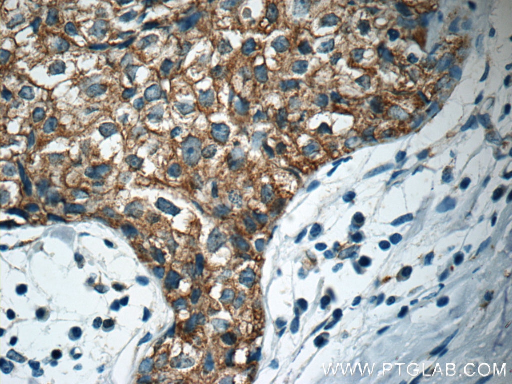IHC staining of human breast cancer using 19782-1-AP