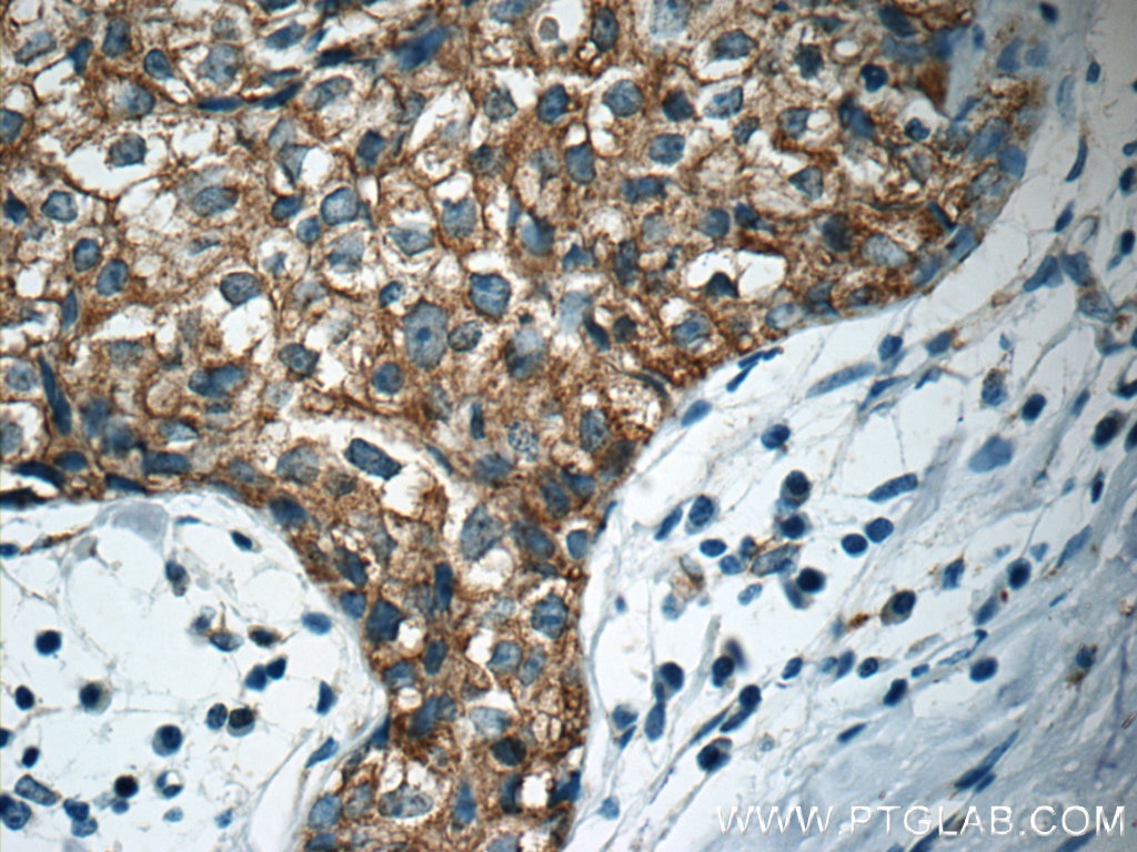 Immunohistochemistry (IHC) staining of human breast cancer tissue using APC Polyclonal antibody (19782-1-AP)