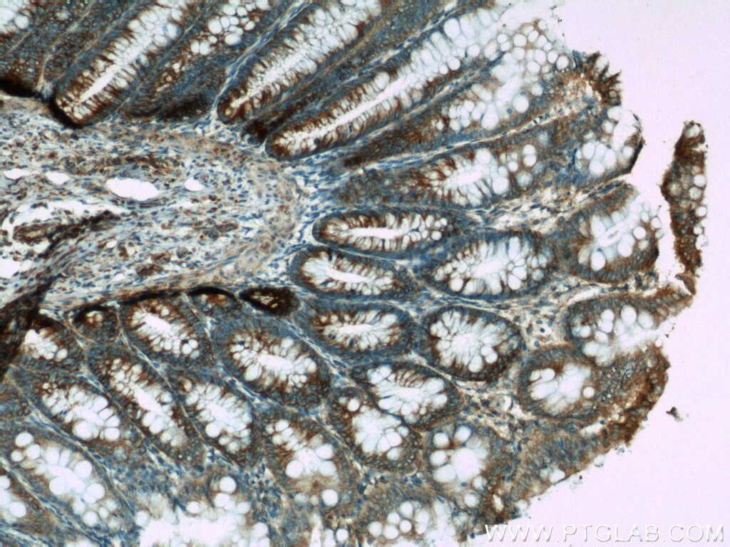 Immunohistochemistry (IHC) staining of human colon tissue using APC Polyclonal antibody (19782-1-AP)