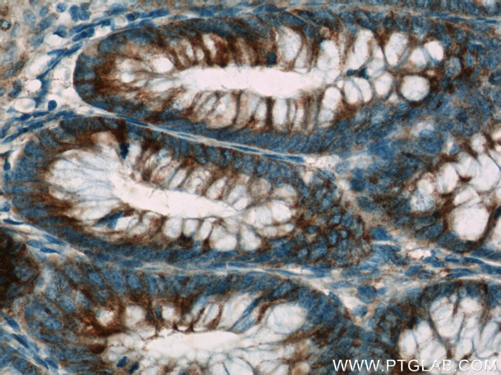 Immunohistochemistry (IHC) staining of human colon tissue using APC Polyclonal antibody (19782-1-AP)