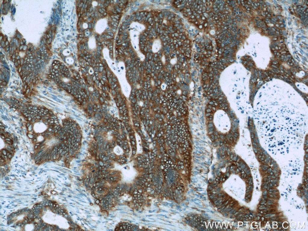 Immunohistochemistry (IHC) staining of human colon cancer tissue using APC Polyclonal antibody (19782-1-AP)