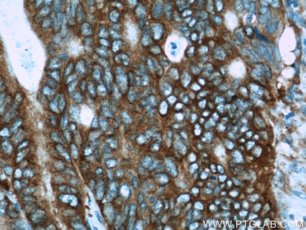 Immunohistochemistry (IHC) staining of human colon cancer tissue using APC Polyclonal antibody (19782-1-AP)