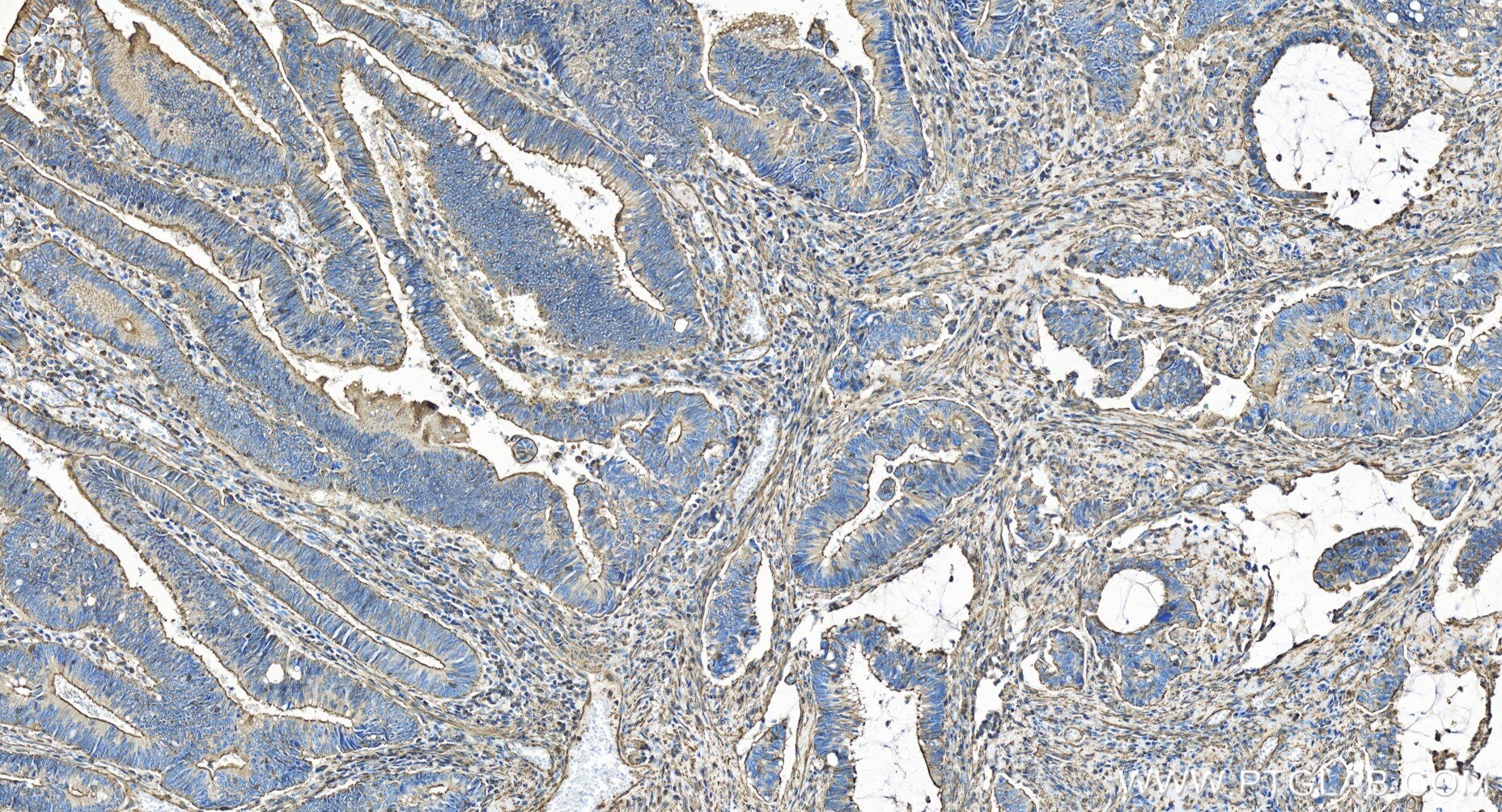 Immunohistochemistry (IHC) staining of human colon cancer tissue using APC Recombinant antibody (85372-1-RR)