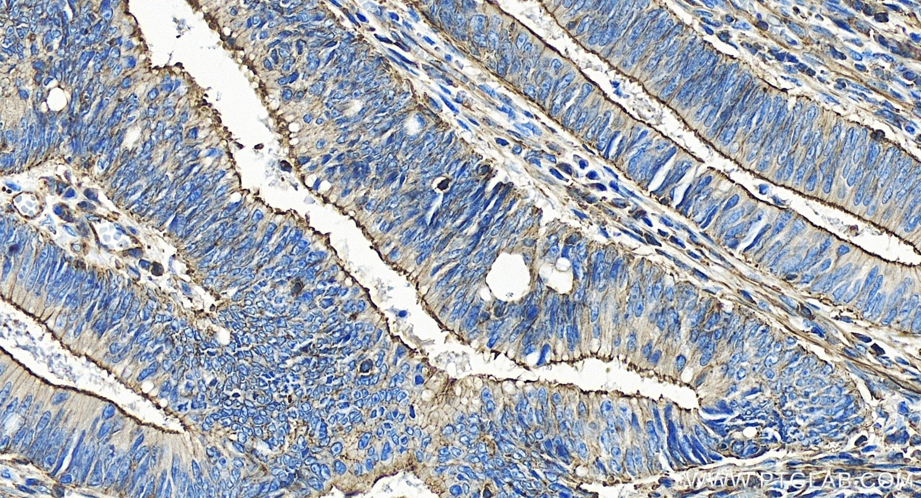 Immunohistochemistry (IHC) staining of human colon cancer tissue using APC Recombinant antibody (85372-1-RR)