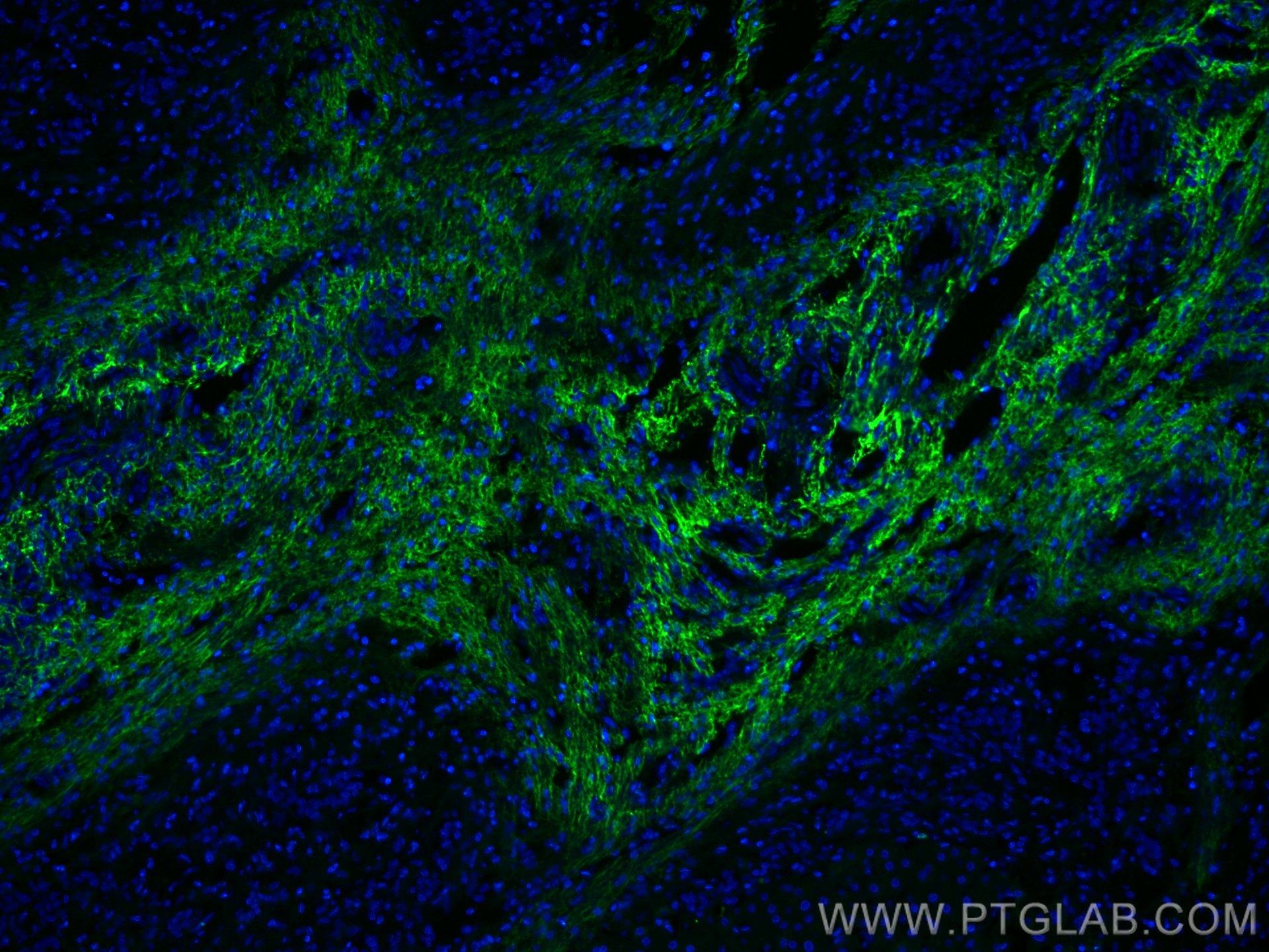 Immunofluorescence (IF) / fluorescent staining of human liver cancer tissue using Serum amyloid P component Monoclonal antibody (66084-1-Ig)