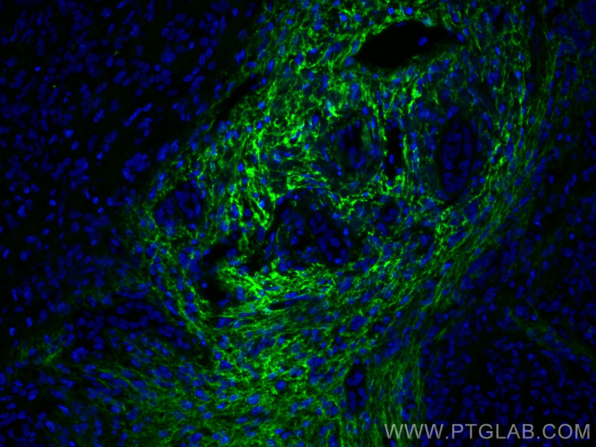 Immunofluorescence (IF) / fluorescent staining of human liver cancer tissue using Serum amyloid P component Monoclonal antibody (66084-1-Ig)