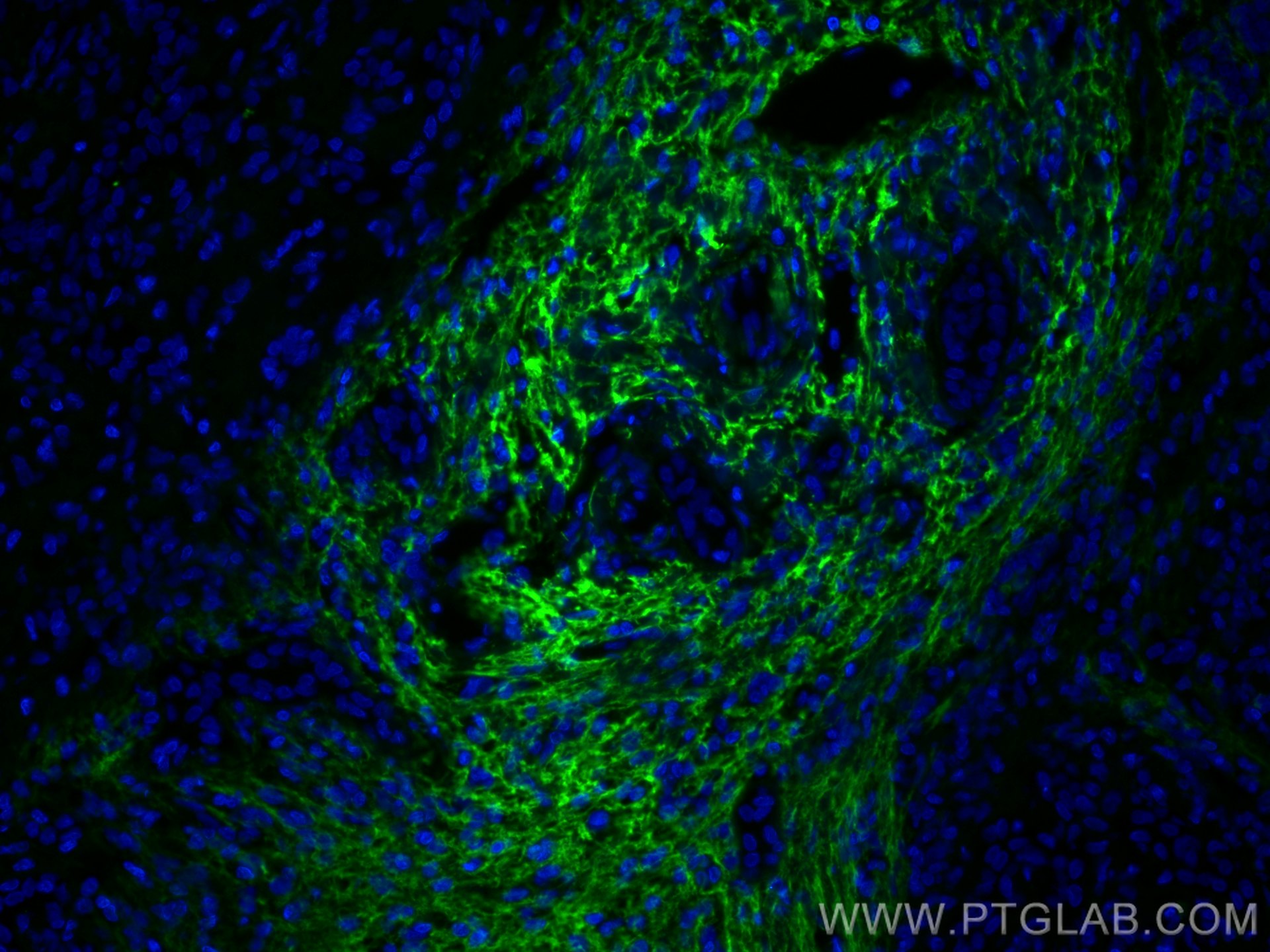 IF Staining of human liver cancer using 66084-1-Ig