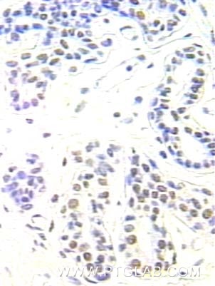 Immunohistochemistry (IHC) staining of human breast cancer tissue using APEX1 Polyclonal antibody (10203-1-AP)