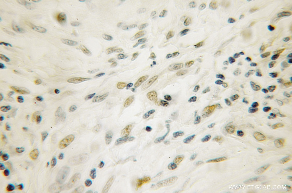Immunohistochemistry (IHC) staining of human cervical cancer tissue using APEX1 Polyclonal antibody (10323-1-AP)